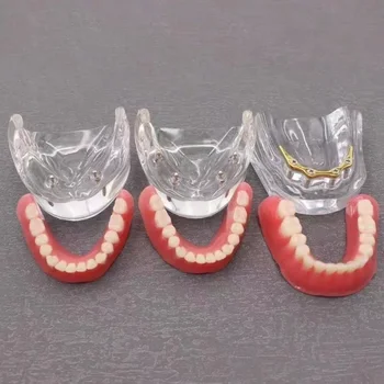 Zobu Modelis: Mandibular Zobs 2-pin un 4-pin Implantu Modeli Ārsta un pacienta Komunikācijas un Reklāmas Modelis